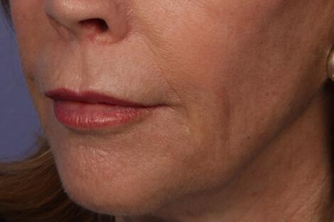 BOTOX® Cosmetic Gallery Before & After Image