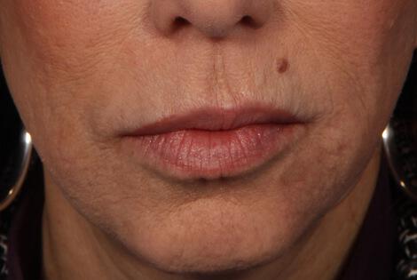 BOTOX® Cosmetic Gallery Before & After Image