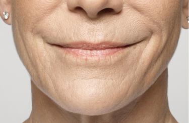 Facial Softening Gallery Before & After Image