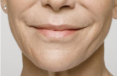 Facial Softening Gallery Before & After Image