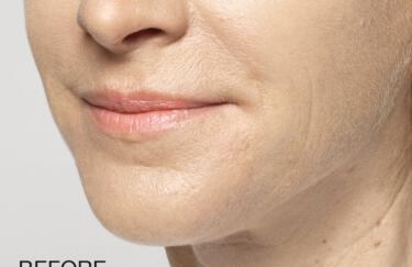 Facial Softening Gallery Before & After Image