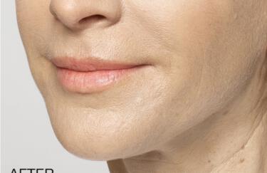 Facial Softening Gallery Before & After Image