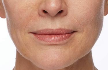 Facial Softening Gallery Before & After Image