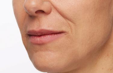 Facial Softening Gallery Before & After Image