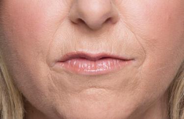 Facial Softening Gallery Before & After Image