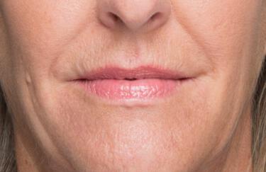 Facial Softening Gallery Before & After Image