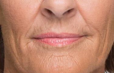 Facial Softening Gallery Before & After Image