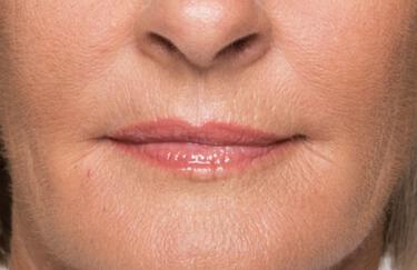 Facial Softening Gallery Before & After Image