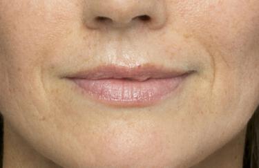 Facial Softening Gallery Before & After Image