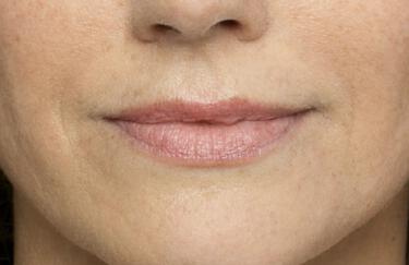 Facial Softening Gallery Before & After Image