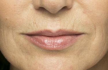 Facial Softening Gallery Before & After Image