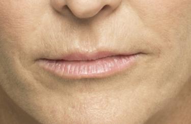 Facial Softening Gallery Before & After Image