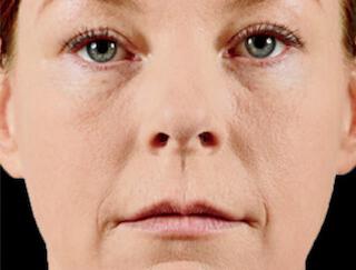 Facial Softening Gallery Before & After Image