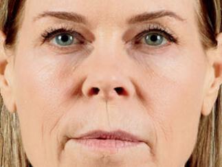 Facial Softening Gallery Before & After Image