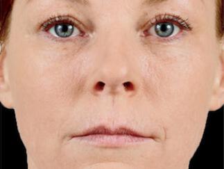 Facial Softening Gallery Before & After Image