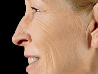 Facial Softening Gallery Before & After Image