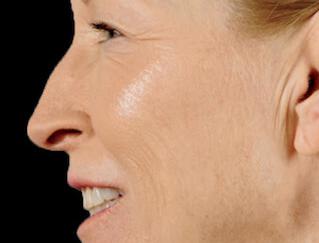 Facial Softening Gallery Before & After Image