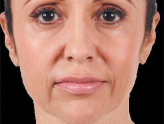 Facial Softening Gallery Before & After Image