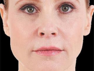 Facial Softening Gallery Before & After Image