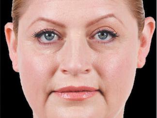 Facial Softening Gallery Before & After Image
