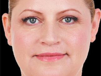 Facial Softening Gallery Before & After Image