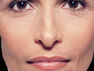 Facial Softening Gallery Before & After Image