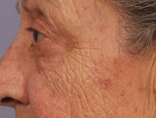 Facial Softening Gallery Before & After Image