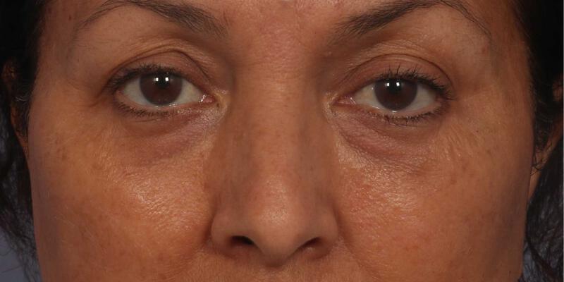 Injectable Fillers Gallery Before & After Image