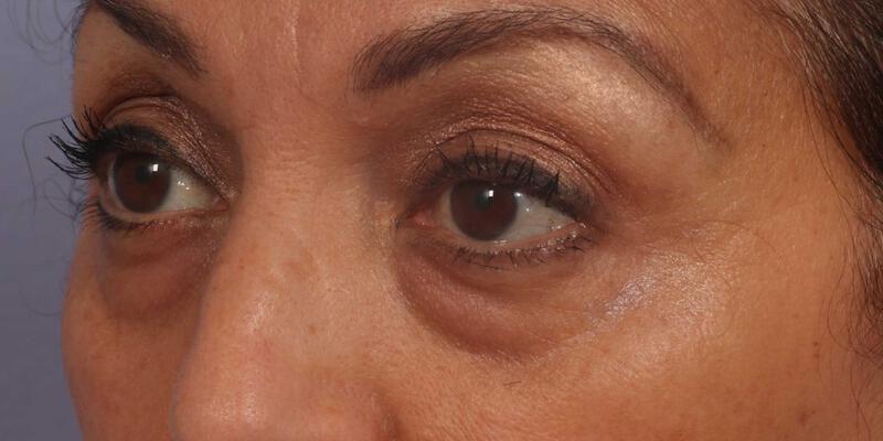 Injectable Fillers Gallery Before & After Image