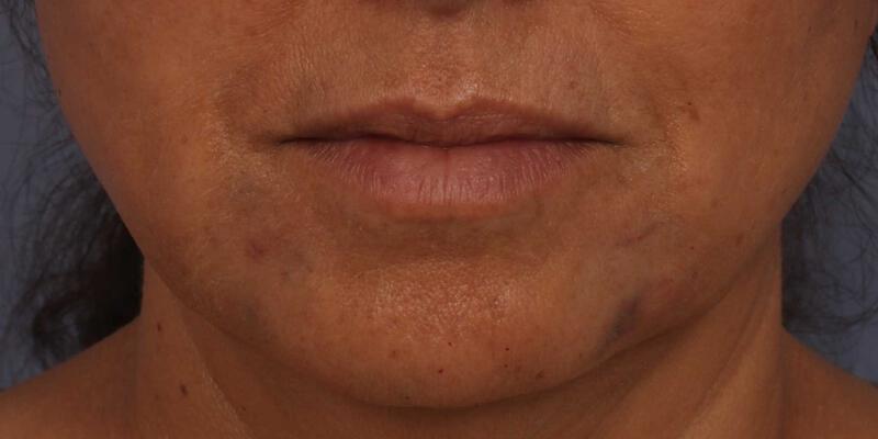 Injectable Fillers Gallery Before & After Image