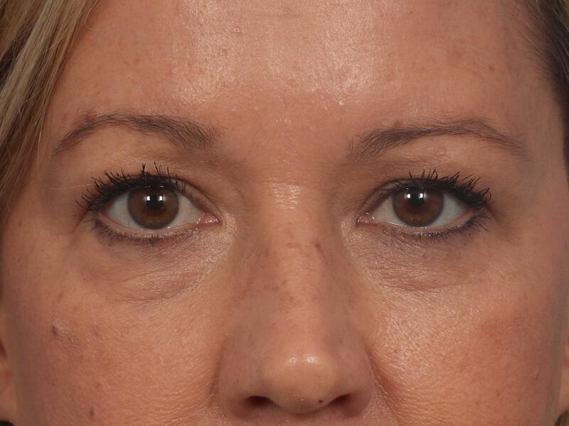 Injectable Fillers Gallery Before & After Image