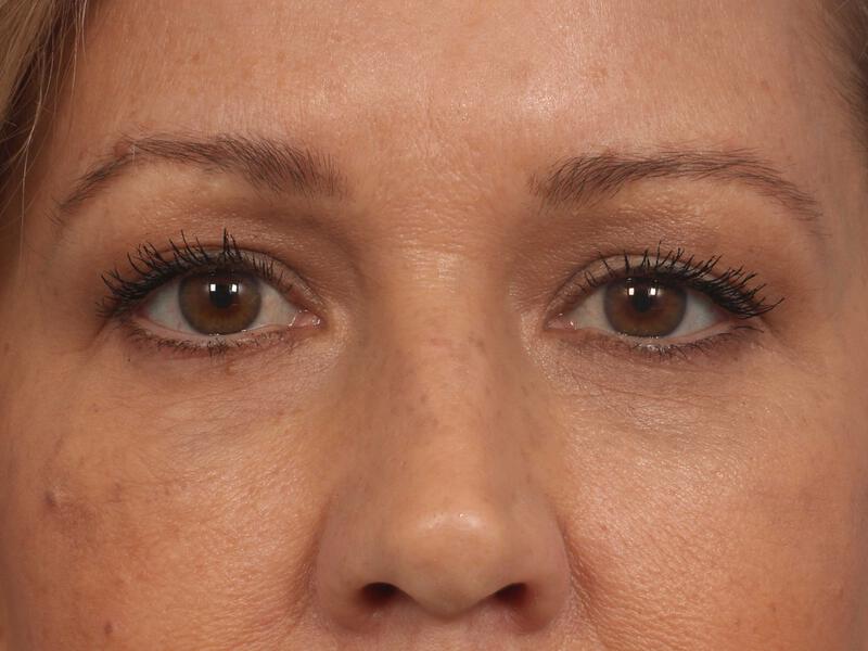 Injectable Fillers Gallery Before & After Image