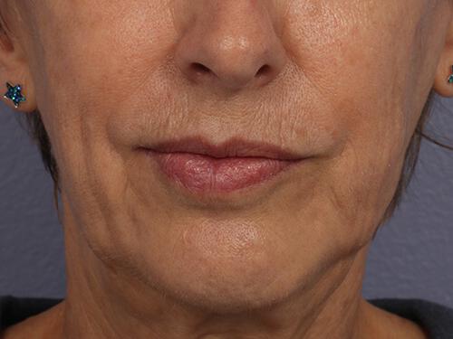 Injectable Fillers Gallery Before & After Image