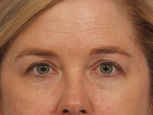 Injectable Fillers Gallery Before & After Image