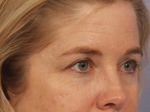 Injectable Fillers Gallery Before & After Image