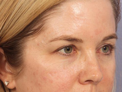 Injectable Fillers Gallery Before & After Image