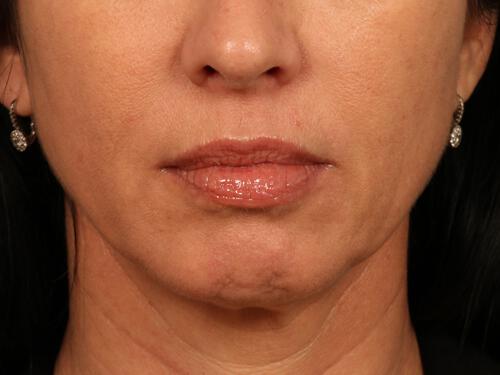 Injectable Fillers Gallery Before & After Image