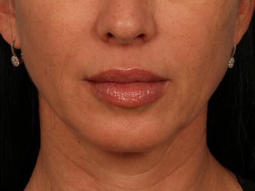 Injectable Fillers Gallery Before & After Image
