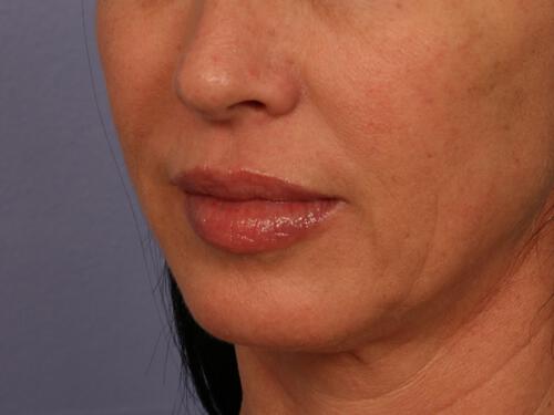 Injectable Fillers Gallery Before & After Image