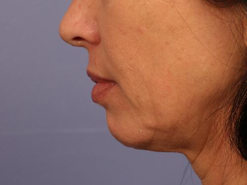 Injectable Fillers Gallery Before & After Image