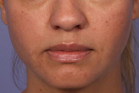 Injectable Fillers Gallery Before & After Image