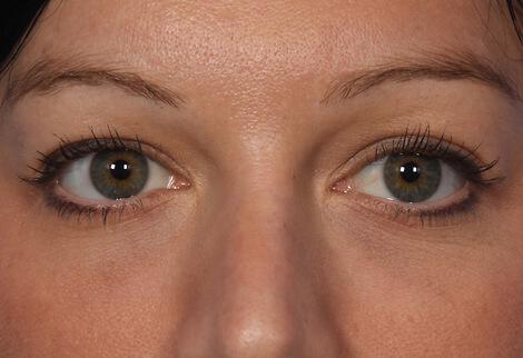 Injectable Fillers Gallery Before & After Image