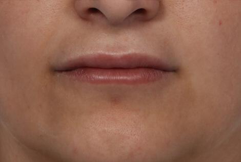 Injectable Fillers Gallery Before & After Image