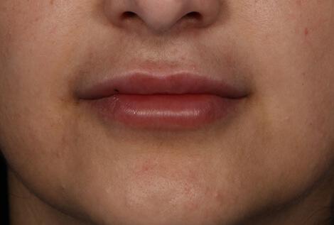 Injectable Fillers Gallery Before & After Image