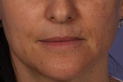 Injectable Fillers Gallery Before & After Image