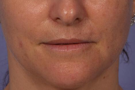 Injectable Fillers Gallery Before & After Image