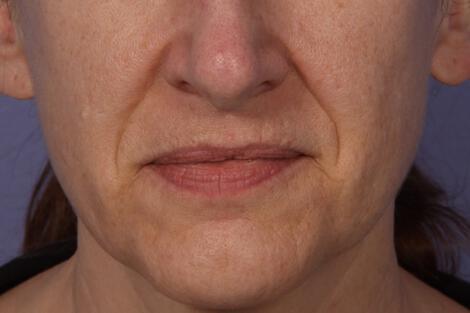 Injectable Fillers Gallery Before & After Image