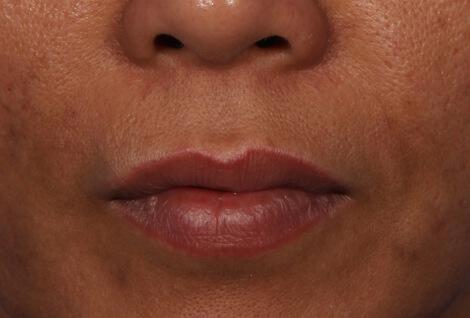 Injectable Fillers Gallery Before & After Image