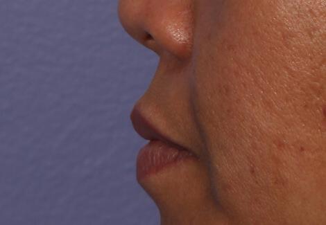 Injectable Fillers Gallery Before & After Image