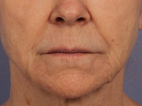 Injectable Fillers Gallery Before & After Image